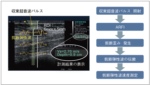 }3@Virtual Touch Tissue Quantification̓vZX