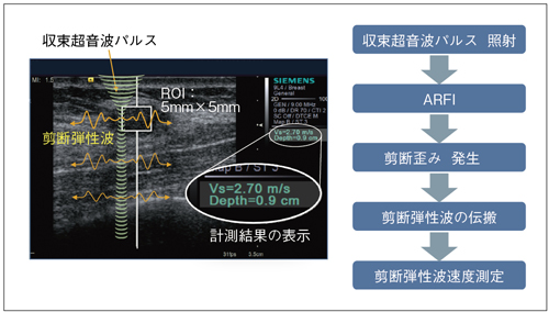 図3　Virtual Touch Tissue Quantificationの動作プロセス
