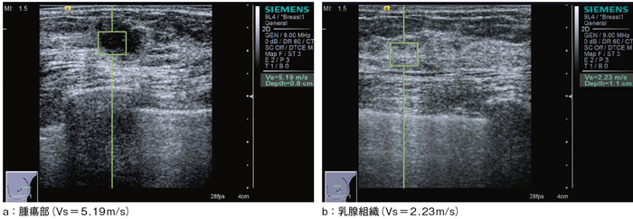 }4@Virtual Touch Tissue Quantification̗iZǊj