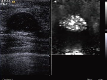 }1@Virtual Touch Tissue Imagingɂ[̔ZkXE̗