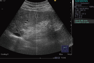 }2@Virtual Touch Tissue Quantification ɂgDdxi̍dρj