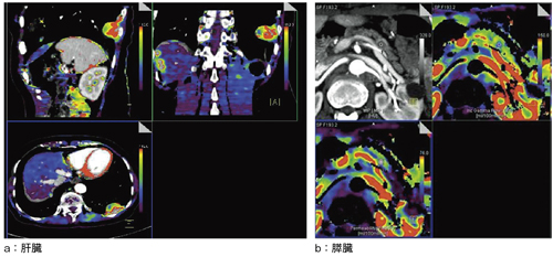 }2@ Adaptive 4D Spiralł 󗬉́iCT Perfusionj