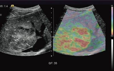 図1　eSie Touch Elasticity Imagingによる臨床例：転移性肝がん