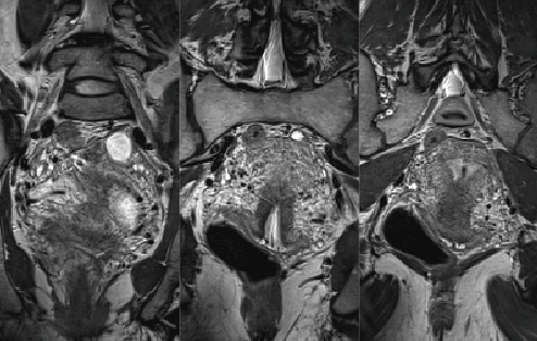 図4　子宮頸部の局所3D画像