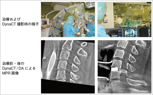 図3　頸椎狭窄患者への外科治療