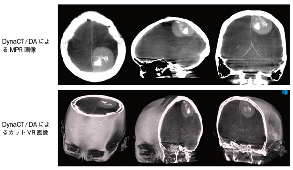 }1@ǐpiPVA formjmeningioma