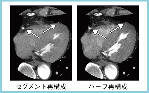 }2@Aquilion ONEł̃ZOgč\ƃn[tč\̔r
