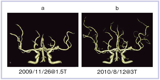 }7@jᎂ̃tH[AbvMRA aF1.5TCbF3T