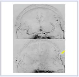 }21@Time-SLIP@ɂ񑢉eMRA