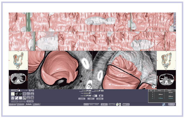 }10@ziostation̑咰WJ摜iVirtual Gross PathologyFVGPjɂelectronic cleansing