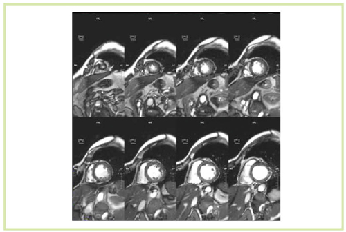 }11@SSFP@ɂVlMRIiTitan 3Tj S؍[ TR/TE3.4/1.7CFA42