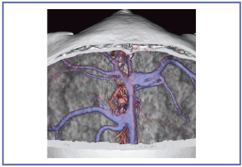 }3@Ǘ2FO]ᎂɑ΂Interhemispheric approach