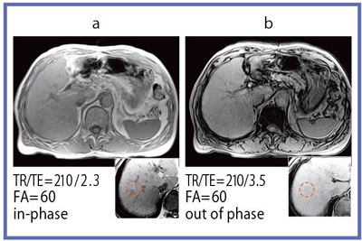 }3@2D GR in-phase/out of phase