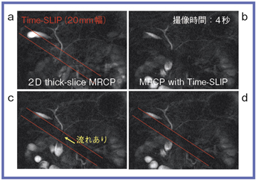 }2@Time-SLIPpcine dynamic MRCPɂXtE_`̗̕`o