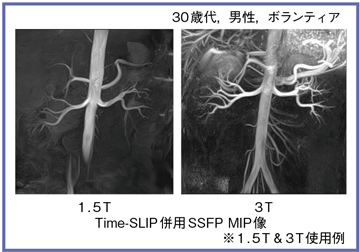 }2@񑢉eMRAF1.5T3T̔r