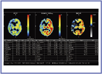図6 NEURO FLEXER ver.10を用いた脳循環予備能評価例(右IC閉塞例)