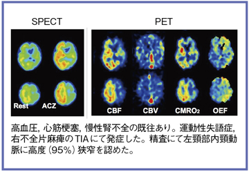 図4 症例2:内頸動脈高度狭窄(78歳,男性)のSPECTおよびPET画像