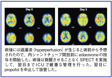 図6 症例3の術後過灌流のSPECT画像