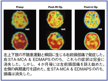 図7 症例4:もやもや病(12歳,男児)のSPECT画像