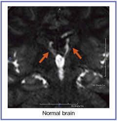 図1 Time-SLIP法による正常脳の描出