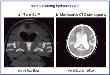 図2 交通性水頭症のTime-SLIP法(a)と Metrizamide CT Cisternography(b)の画像