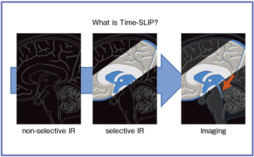図3 Time-SLIP法によるCSF描出の原理