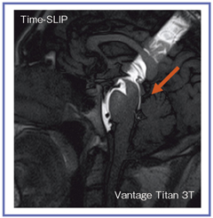 図4 Titan 3TによるTime-SLIP法のCSF flow imaging 中脳水道を通る髄液が高画質に描出されている。