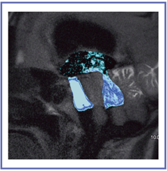 図9 Time-SLIP法によるクモ膜下出血後の水頭症