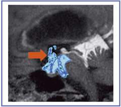 図12 Time-SLIP法によるETV後の髄液の流れの観察