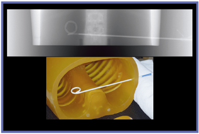 }7@Aquilion ONEłCT fluoroscopy