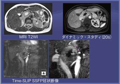 図1 症例1:副腎褐色細胞腫(40歳代,女性)