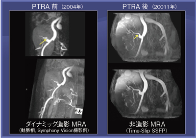 }3@Ǘ3FڐAtɑ΂PTRAi60ΑCC̐tڐA4j