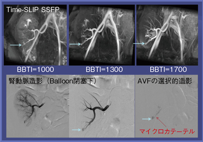 図4 症例4:移植腎動静脈瘻,BBTIによる描出の違い(3T,30歳代,女性)