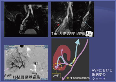 図5 動静脈瘻に伴う移植腎動脈の偽狭窄(3T,40歳代,男性)