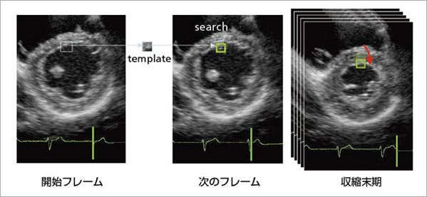 図1　スペックルトラッキング