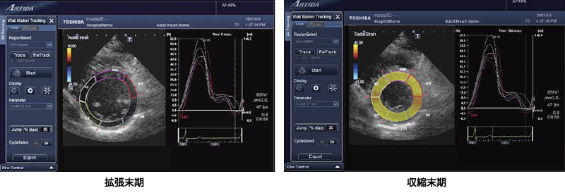 図5　パラメトリックイメージングとグラフ表示（radial strain）