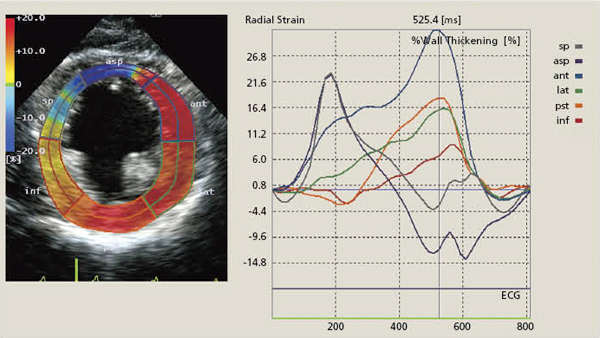 図8　LBBBでのストレイン解析結果