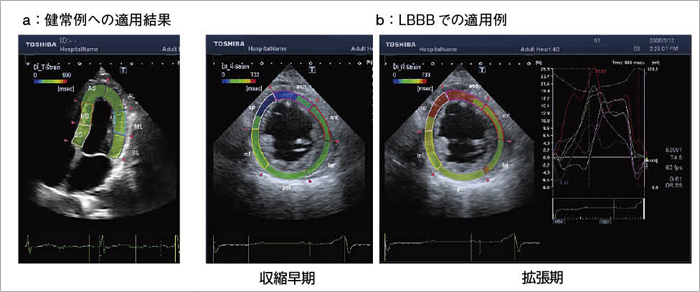 図10　スペックルトラッキングによるDyssynchrony Imaging（画像ご提供：筑波大学・瀬尾由広先生）