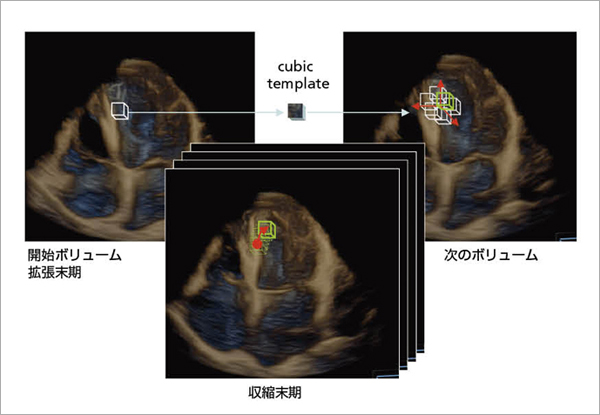 図11　三次元画像での三次元スペックルトラッキング