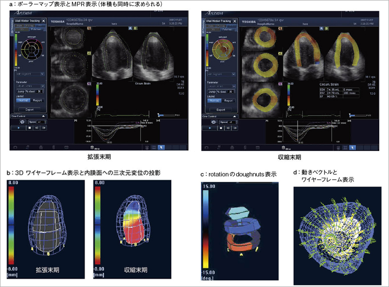 図14　3Dトラッキングによるパラメトリックイメージング