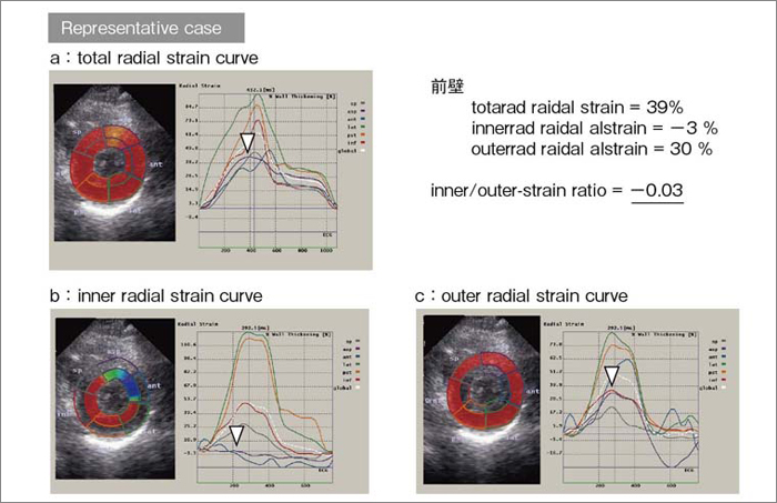 図4 左前下行枝の高度狭窄例のradial strain 曲線(54歳,男性,不安定狭心症)