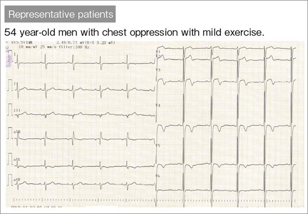 図5 図4の症例の心電図