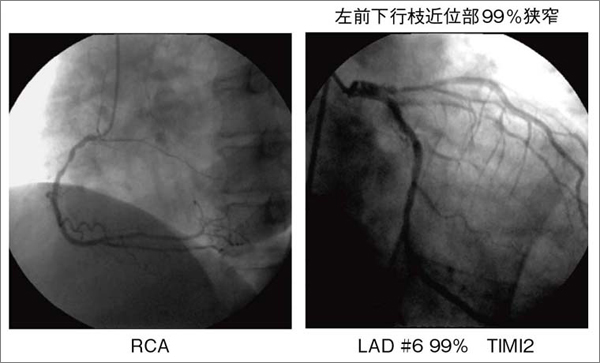 図6 図4の症例の冠動脈造影所見