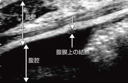 図13 大腸がん症例に見られた播種性の腹膜結節