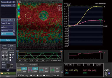 Elastography