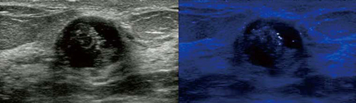 図2　Bモード画像（左）とMicroPure（右）