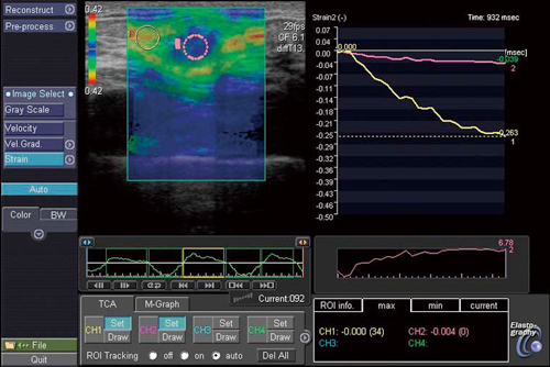 図3　Elastography