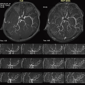 }6@1.5THOP-MRA̗ՏFE]ǁCESTA-MCAp̏p]