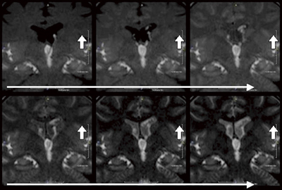 }3@񑢉eɂĕ`oꂽCSF-flowi1.5T MRIj