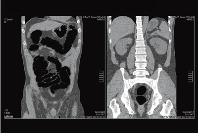 }2@CTC Hi-Helical Pitch ScaniBP1.48CHP95j 